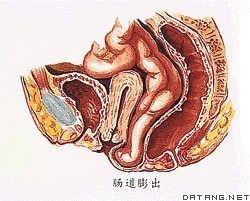 肠膨出